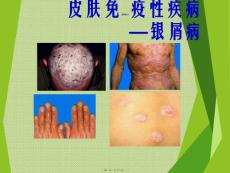 银屑病ppt课件