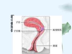 宫颈癌分期