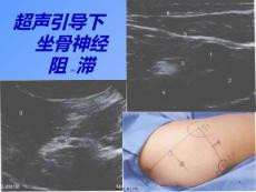 坐骨神经阻滞ppt课件