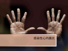 感染性心内膜炎