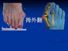 拇外翻分析课件