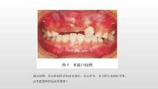 口腔颌面部肿瘤病理—口腔颌面部囊肿（口腔组织病理学课件）