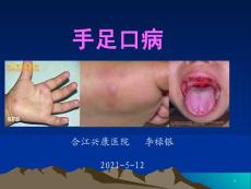 手足口病课件
