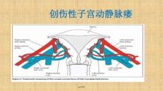 子宫动静脉瘘课件