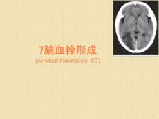 脑血栓形成课件
