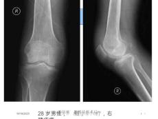 膝关节结核的影像学诊疗培训ppt课件