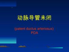 动脉导管未闭