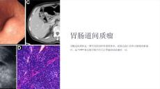 《胃肠道间质瘤》课件