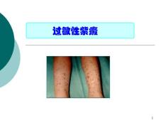 过敏性紫癜 课件