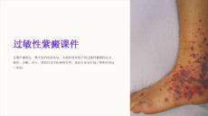 过敏性紫癜课件