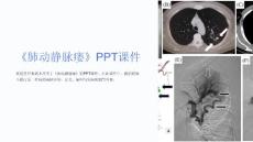 《肺动静脉瘘》课件