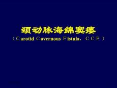 颈动脉海绵窦瘘-课件