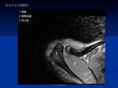 肩關(guān)節(jié)MR解剖課件