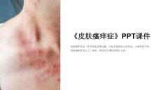 《皮肤瘙痒症》课件