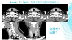 甲狀腺腺瘤和甲狀腺癌影像診斷