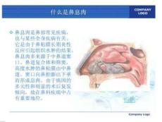 鼻息肉护理.ppt