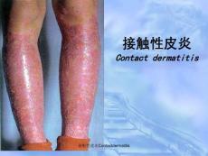 接触性皮炎Contactdermatitis