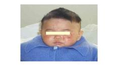 特发性血小板减少性紫癜课件