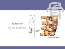 脊柱骨折.ppt