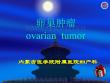 卵巢肿瘤ovariantumor