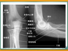 肘关节脱位.ppt