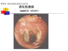 胃炎Gastritis分类急性胃炎慢性胃炎特殊类型胃炎课件.ppt