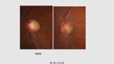 青光眼及非青光眼视神经损害之三.pptx