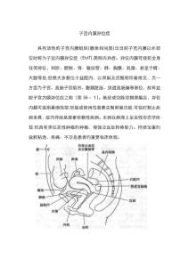 子宫内膜异位症