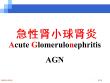急性肾小球肾炎