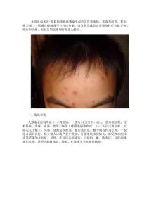水痘防治知识