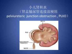 小儿肾积水