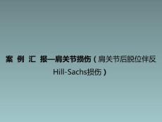 肩关节损伤肩关节后脱位伴反Hill-Sachs损伤课件