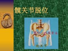 髋关节脱位课件