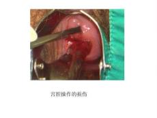 慢性宫颈炎病史