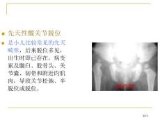 先天性髋关节脱位培训课件