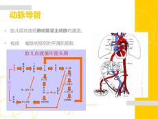 动脉导管未闭讲解