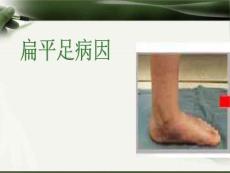 扁平足