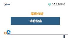 案例分析动脉栓塞