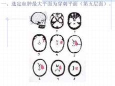 颅内血肿CT片定位