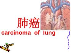《肺癌》课件