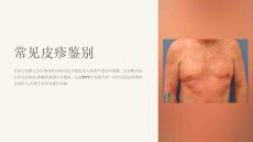 《常见皮疹鉴别》课件