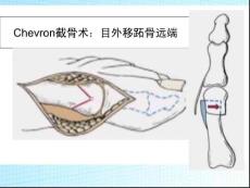 2025年Chevron截骨技巧提升實操班