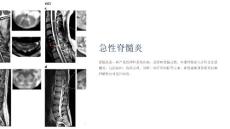 《急性脊髓炎》课件