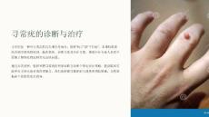 《寻常疣的诊断与治疗》课件