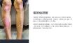 《银屑病讲解》课件