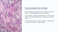 《软组织肿瘤与良性肿瘤》课件