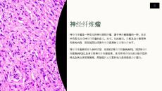 《神经纤维瘤》课件