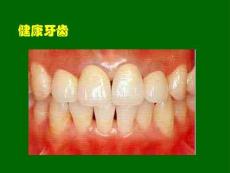 深度解析齲齒病變及高清圖庫培訓課件