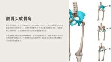 《股骨头软骨病》课件