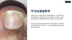 《甲沟炎健康教育》课件